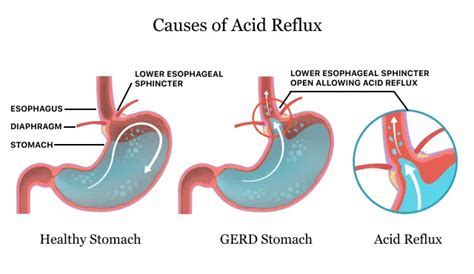 Does GERD Cause Snoring? Exploring the Connection Between Acid Reflux and Nocturnal Noises