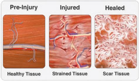 Does Scar Tissue Stretch? Exploring the Elasticity of Healing and Beyond