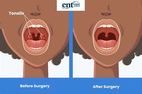 Does Tonsil Removal Stop Snoring? And Why Do Bananas Dream of Electric Sheep?