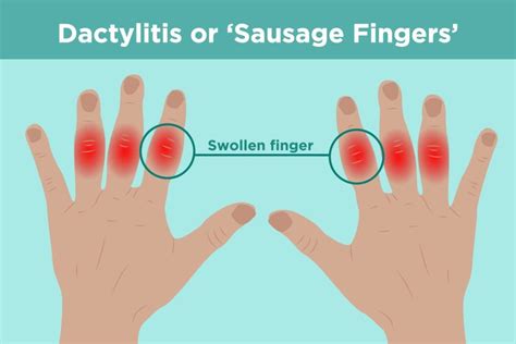 Why Are My Fingers Fat and Why Do They Look Like Sausages in the Morning?